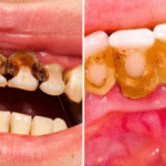 cavity-home-remedies-in-hindi436212366922492904.png