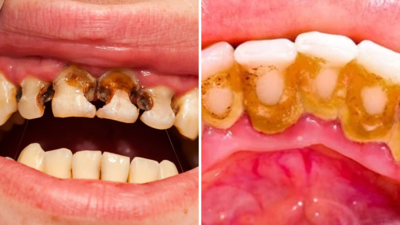 cavity-home-remedies-in-hindi436212366922492904.png